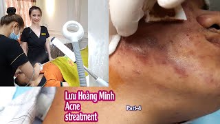 Enlarged Cystic Acne I Điều trị mụn nang khổng lồ Hiền Vân Spa I Trần Văn NhânI 505 [upl. by Ja]