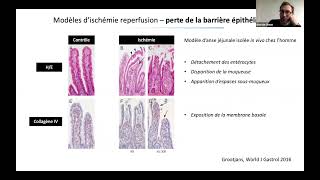 Ischémie mésentérique  Simon BOURCIER [upl. by Edas]