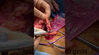 Inside the OR with justageneralsurgeon  hernia contents amp ligasure of omental fat before repair [upl. by Rebmat]