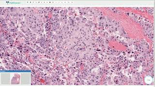 Medullary Carcinoma  Thyroid Gland Histopathology [upl. by Gensler]