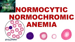 NORMOCYTIC NORMOCHROMIC ANEMIA Causes Mechanism amp Approach [upl. by Eveineg273]