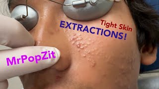 Tight skin acne extractions Comedonal acne with some inflammatory nodules Great session must see [upl. by Blatt209]