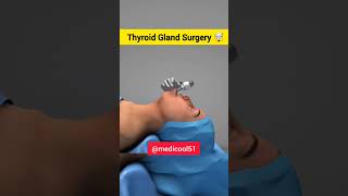 Thyroid gland surgery in 3d shorttrendingshorts thyroid surgeryreview viralshort [upl. by Dun]