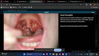 Otolaryngology ENT Sore Throat [upl. by Atilef]