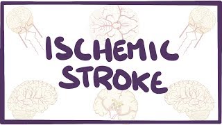 Ischemic Stroke  causes symptoms diagnosis treatment pathology [upl. by Shetrit]