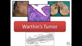 Warthins tumor [upl. by Atnoid]