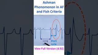 Ashman Phenomenon in AF and Fish Criteria [upl. by Eirroc]