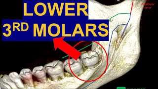 Secrets of Impacted Lower Third Molars CBCT Surgical extraction of wisdom teeth removal surgery [upl. by Ot147]