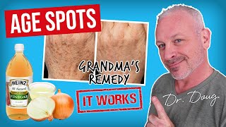 Brown AGE SPOT REMEDY Onion Juice and ACV [upl. by Nosmoht]