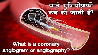 दिल की नसों का हाल जानने के लिए किया जाने वाल टेस्ट एंजियोग्राफी  Angiography in Hindi [upl. by Rolf]