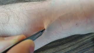 How to Remove a Tick Safely in 3 Easy Steps With Tweezers [upl. by Ahsaei]