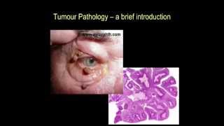 Tumour pathology  a brief introduction part II [upl. by Osanna]