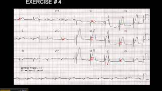 1215 Lead ECG Exercise  4 [upl. by Nuahsyt922]