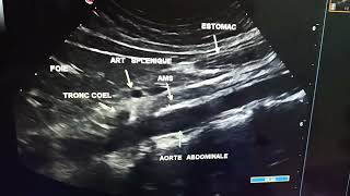 Échographie abdominale lAorte abdominale et ses bronches [upl. by Kahcztiy]