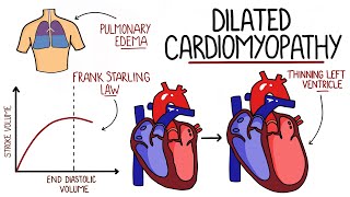 Dilated Cardiomyopathy Made Easy DCM [upl. by Adore]