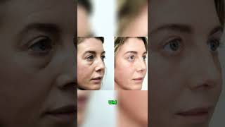 Blepharoplasty Recovery  Day 5 after surgery [upl. by Gney]