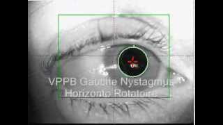 VPPB gauche nystagmus horizontal rotatoire [upl. by Tiram]