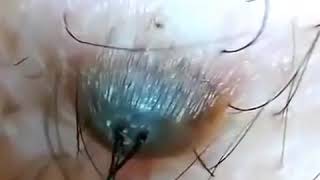 LONGEST HAIR Removal from Follicle [upl. by Ebsen]