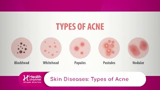 Types of Acne [upl. by Thomasin43]