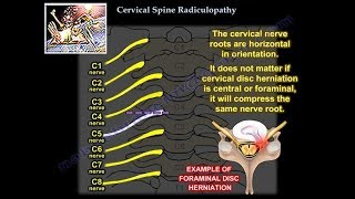 Cervical Radiculopathy  Everything You Need To Know  Dr Nabil Ebraheim [upl. by Ettessil]