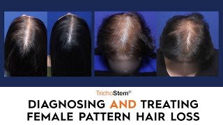 Diagnosing and Treating Androgenetic Alopecia in Women [upl. by Delcine]