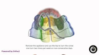 Upper Removable Expander Schwartz Appliance [upl. by Evita339]