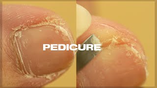 Satisfying PEDICURE TRANSFORMATION at home  Cuticle amp Callus Removal [upl. by Dry]