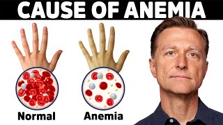 The Hidden Cause of Anemia Youve Never Heard About [upl. by Aia]