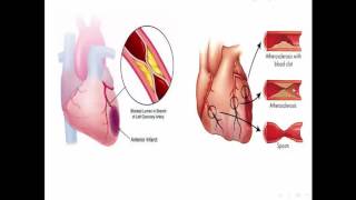 Acute coronary Syndrome مبدعووون  Dr Noha Yaseen [upl. by Beuthel]