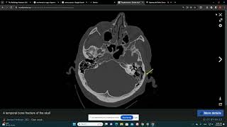 נוירוכירורגיה שבר בסיס גולגולת Basilar Skull Fracture [upl. by Draned836]