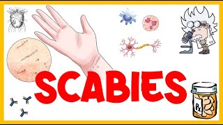 Scabies  Life Cycle Pathogenesis Types Signs amp Symptoms Risk Factors Diagnosis amp Treatment [upl. by Seve]