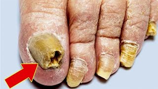 Isso é um exterminador de micose de unhas Funciona rápido demais😱 [upl. by Dihahs]