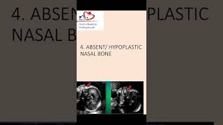 Absent or hypoplastic nasal bone an antenatal scan nasalbone hypoplasticnasalbone [upl. by Charlotta821]