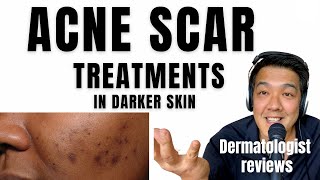 ACNE SCAR TREATMENTS  In Ethnic Skin [upl. by Lydnek]