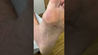 Say goodbye to discomfort Join us in this bunion hard skin removal journey FootCare BunionBeGone [upl. by Nylehtak401]