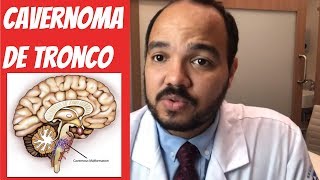 Cavernoma de Tronco Cerebral [upl. by Otreblasiul]