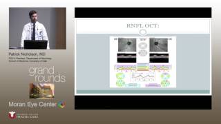 Central Serous Retinopathy vs Optic Neuritis Treatment Implications [upl. by Rumilly]