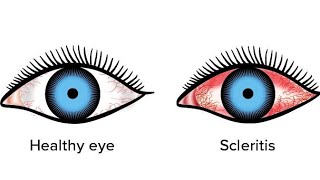 ScleritisEpiscleritis  in very easy way eyedisorders scleritis episcleritis shalakyatantra [upl. by Herrle]