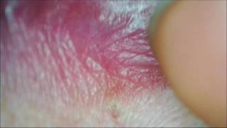 Espinilla gigante en el labio Lip blackhead [upl. by Bowen113]