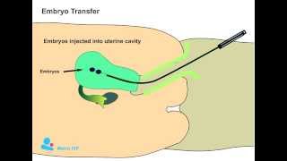 Embryo Transfer procedure [upl. by Kalil213]