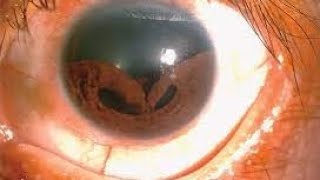 Abnormal Iris condition explained in detail eyecareoptom5506 optometry short eye trending [upl. by Ahcmis]