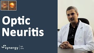 What is Optic Neuritis and What Are the Signs Symptoms and Treatment [upl. by Ilyk246]