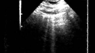 The quotlung pulsequot an early ultrasound sign of complete atelectasis [upl. by Fina]