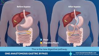 One Anastomosis Gastric Bypass [upl. by Dworman]