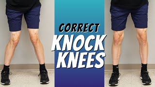 Top 5 Ways to Correct Knock Knees with Exercise Etc [upl. by Lavotsirc]