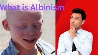 What is Albinism Albinism ratio in children Albinism definition Health Slash [upl. by Atiekahs762]