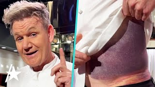 Gordon Ramsay Reveals MASSIVE Bruise After Bike Accident [upl. by Wyndham239]