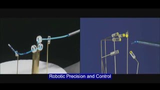 Cardiac Ablation Catheter Precision and Reach with Stereotaxis RMN [upl. by Bonnette759]