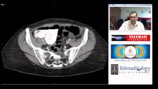 Splenic Rupture Following Colonoscopy by Dr Arjun Kalyanpur [upl. by Anaejer]