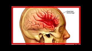 Ischemia cerebrale sintomi diagnosi e cura [upl. by Graybill]